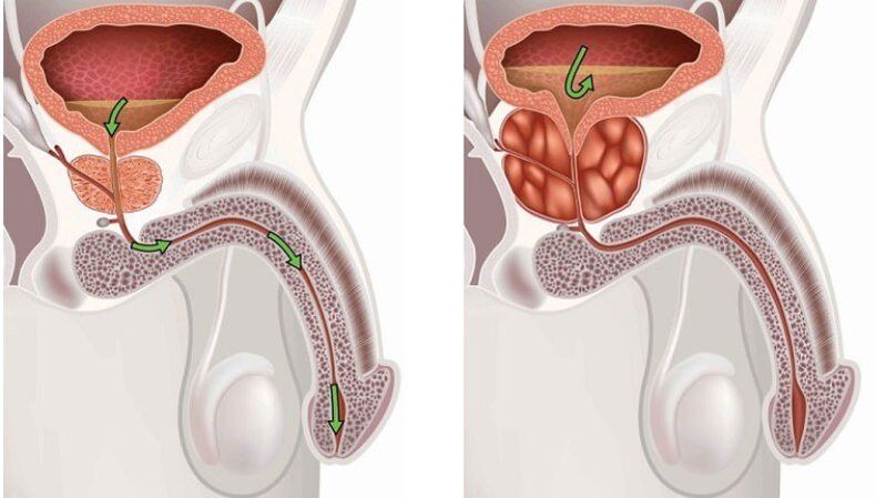 ghiandola prostatica sana e infiammata con prostatite