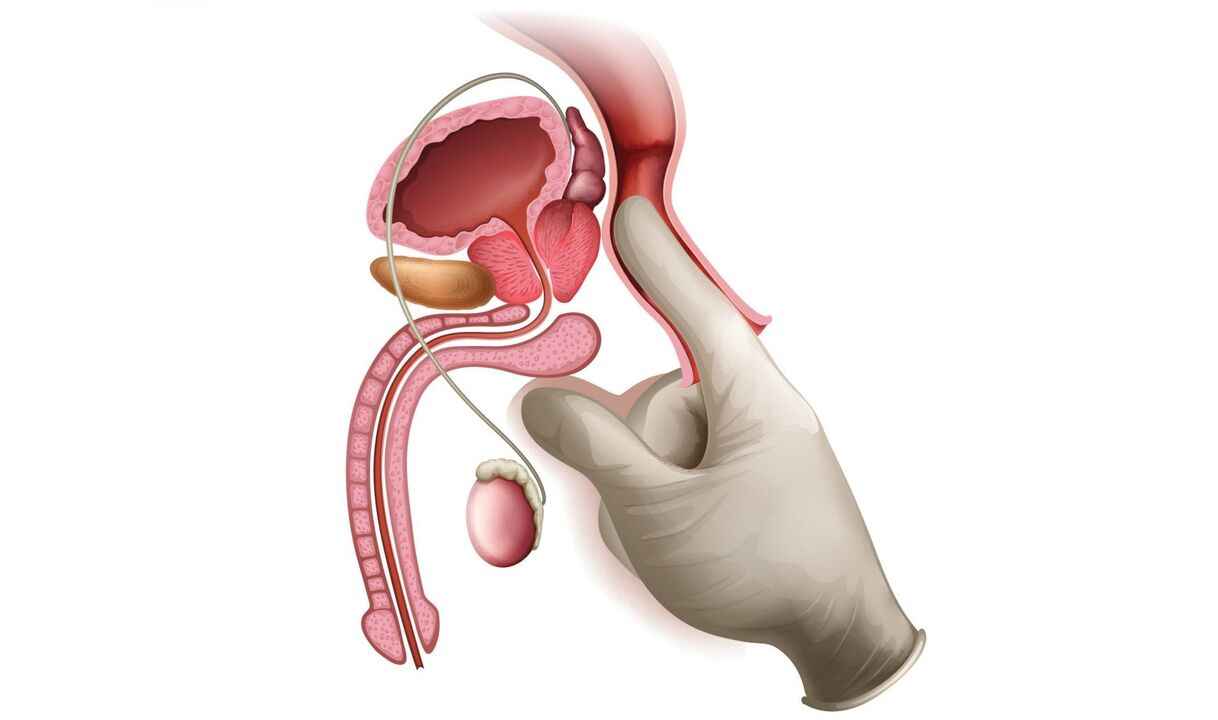 massaggio prostatico per prostatite